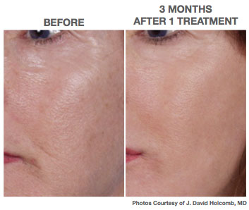 nano before laser peel treatments skin