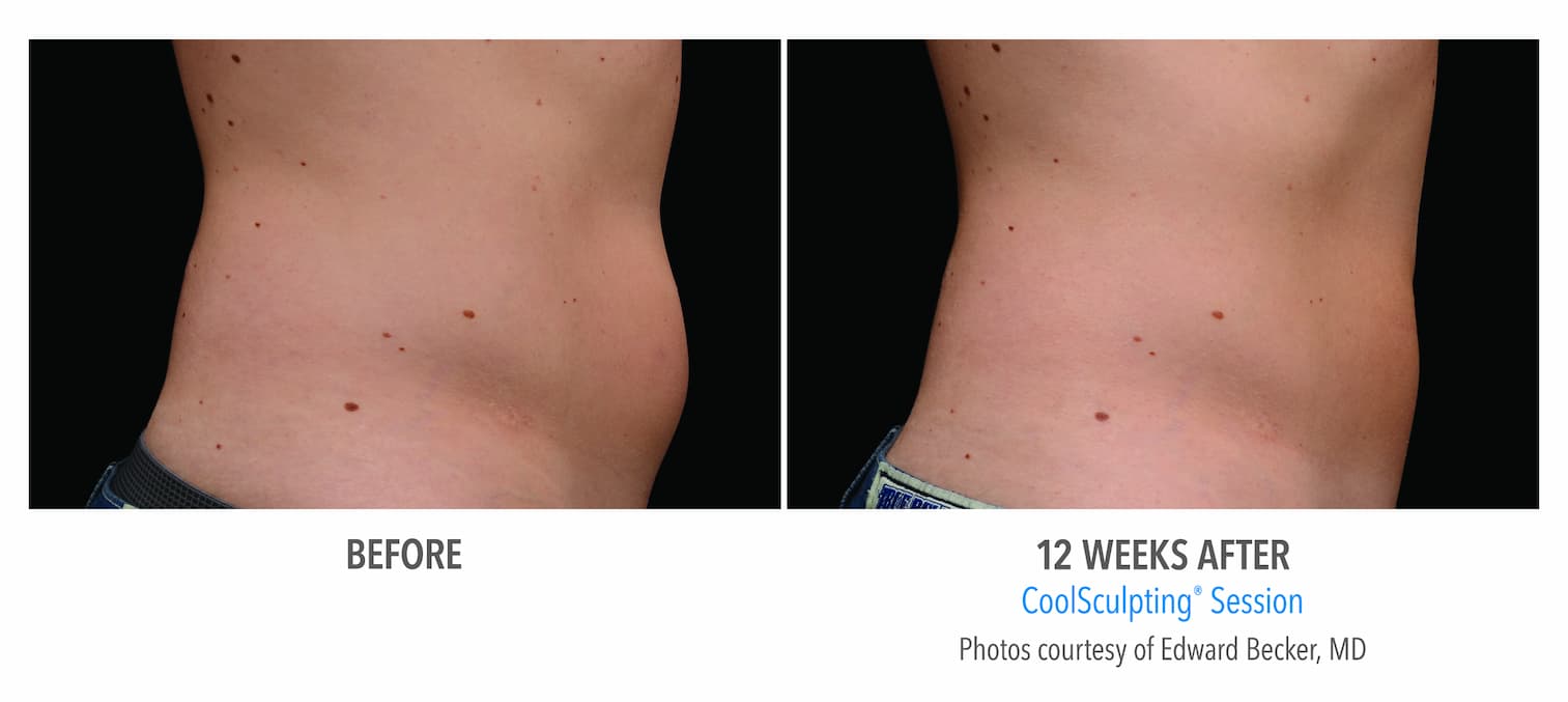 Coolsculpting  Renew Laser and Skin Clinic