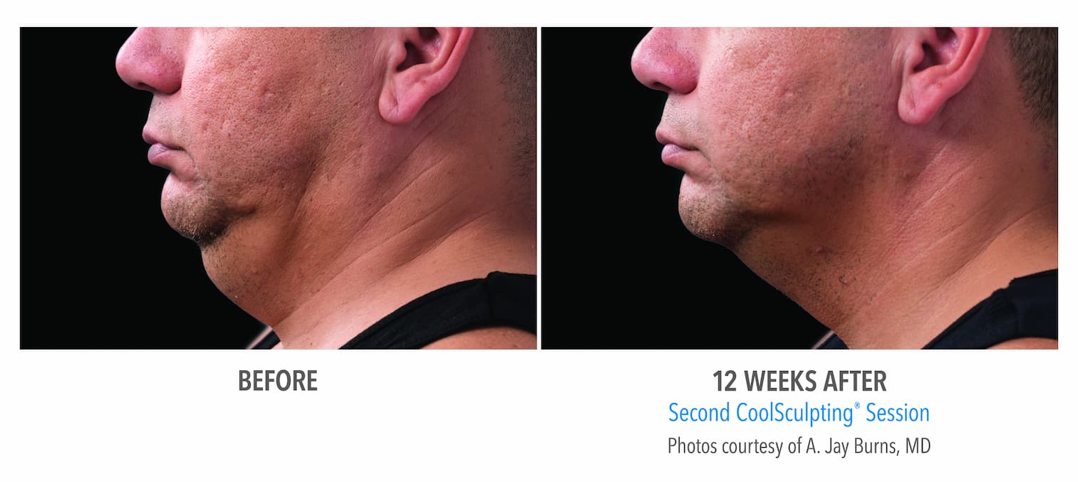 Coolsculpting Before and After