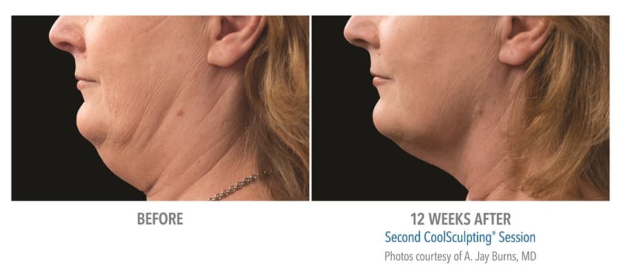 Coolsculpting Before and After