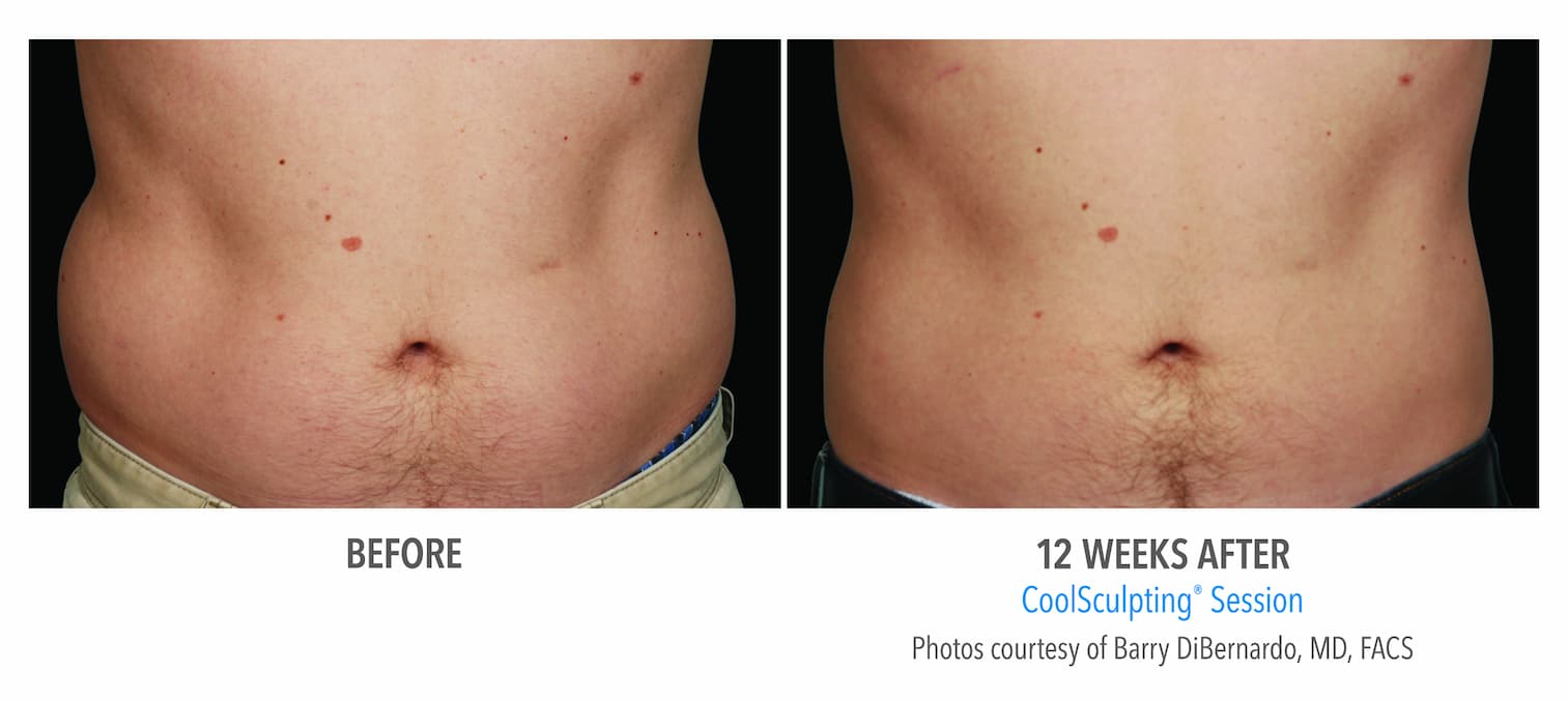 Coolsculpting  Renew Laser and Skin Clinic