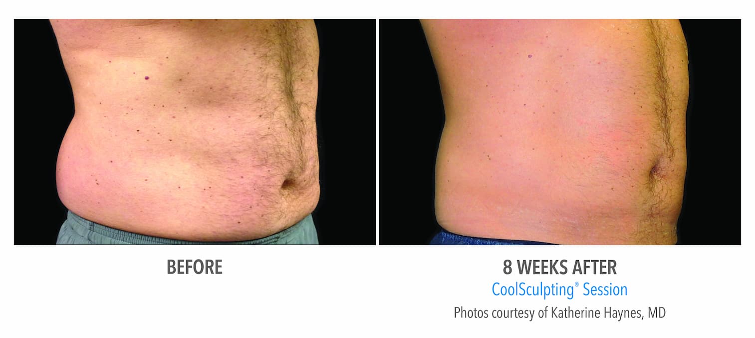 Coolsculpting Before and After